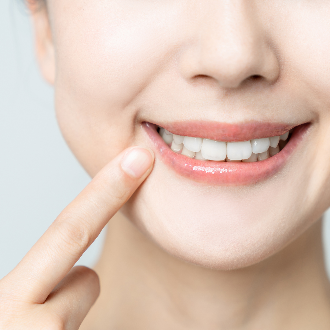 Natural-looking smile enhanced with porcelain veneers